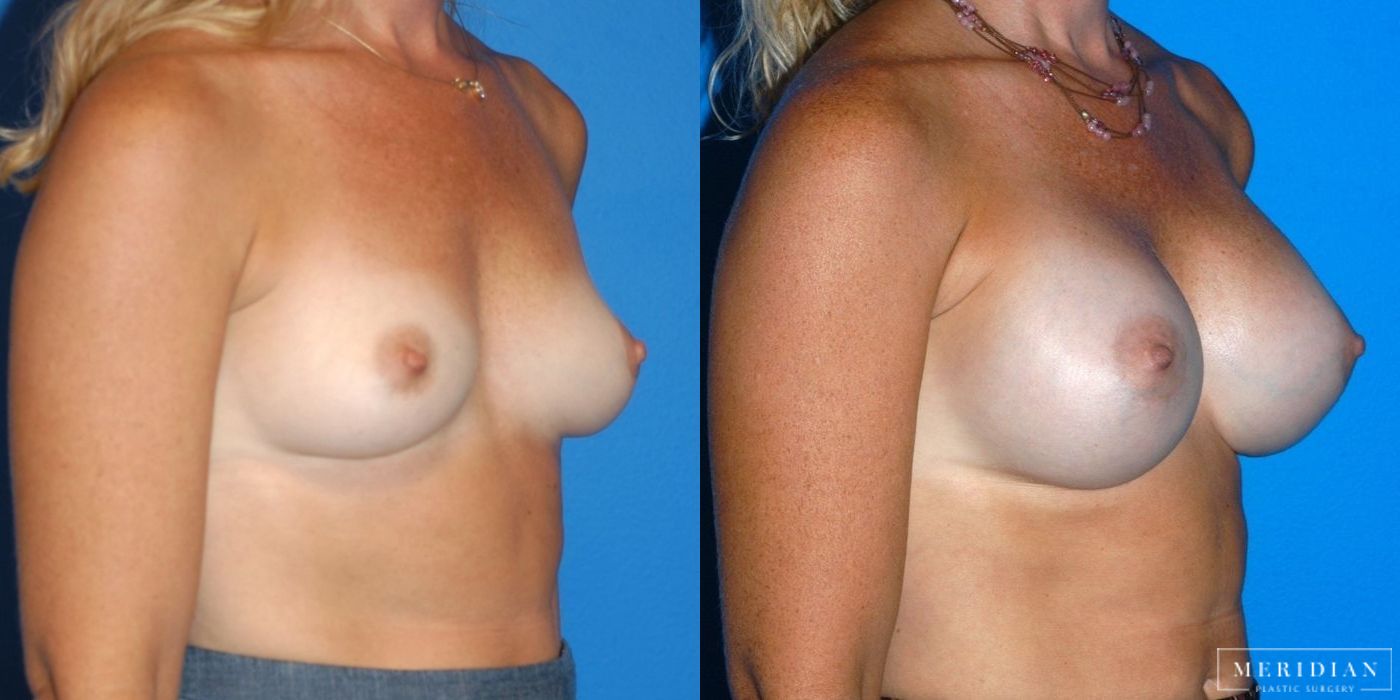 Breast Augmentation - Thumbnail 2