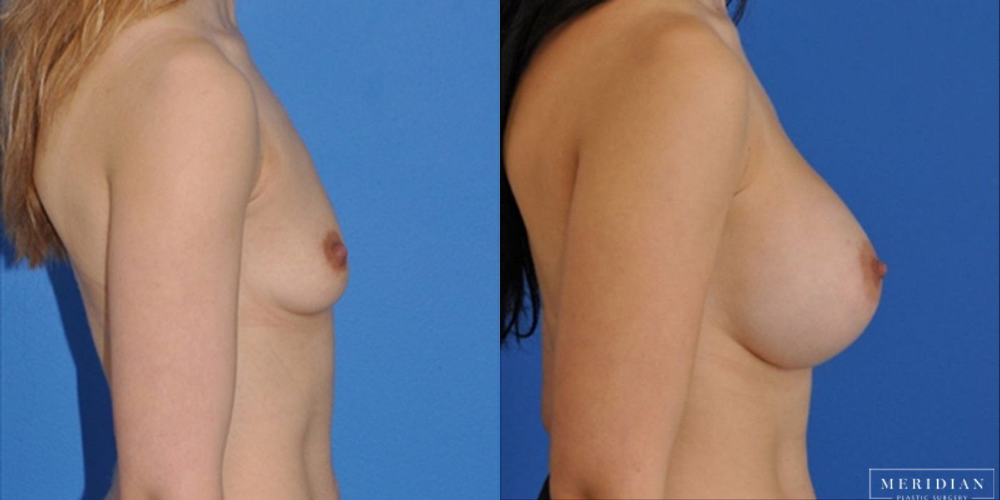 Breast Augmentation - Case 8519