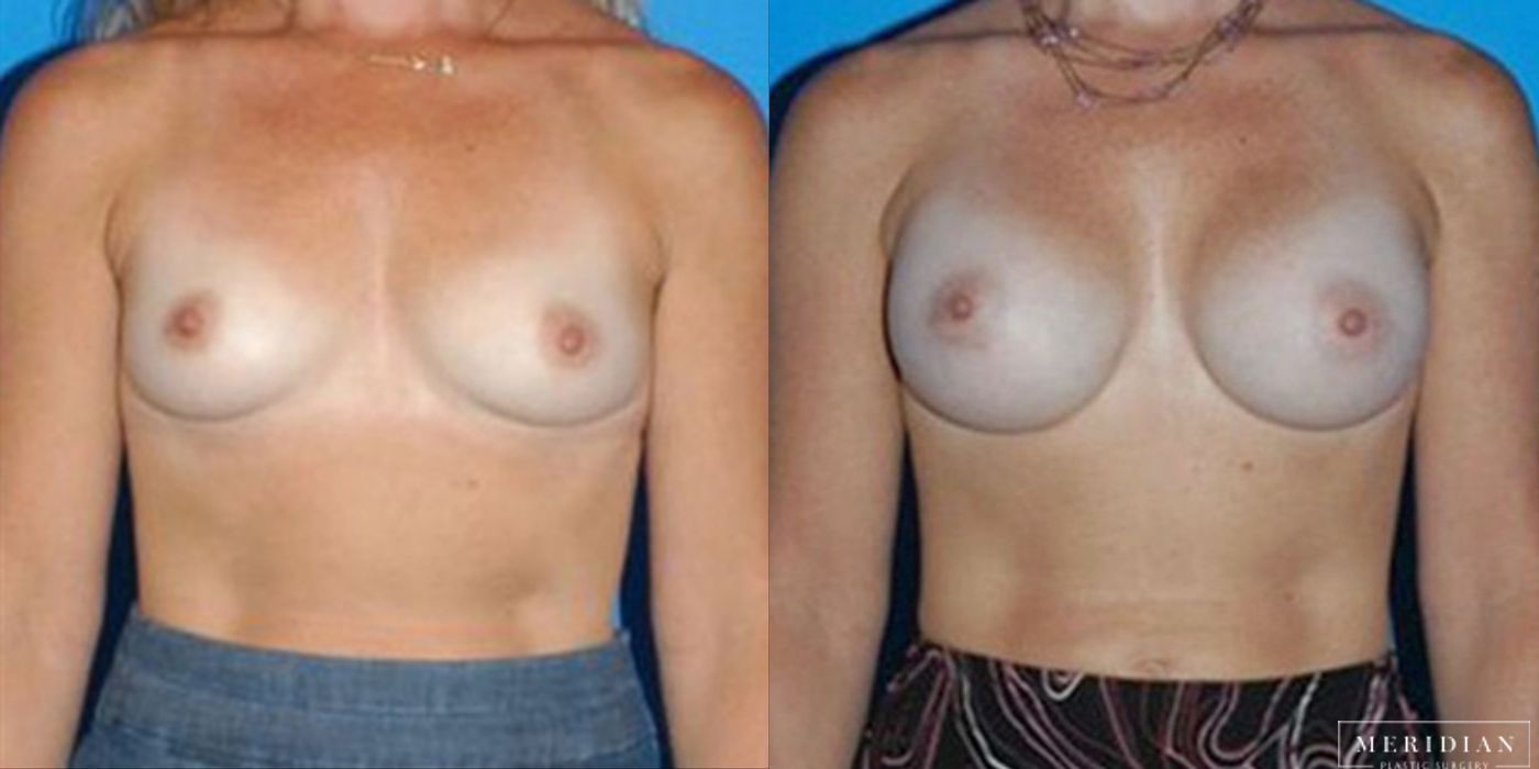 Breast Augmentation - Thumbnail 2