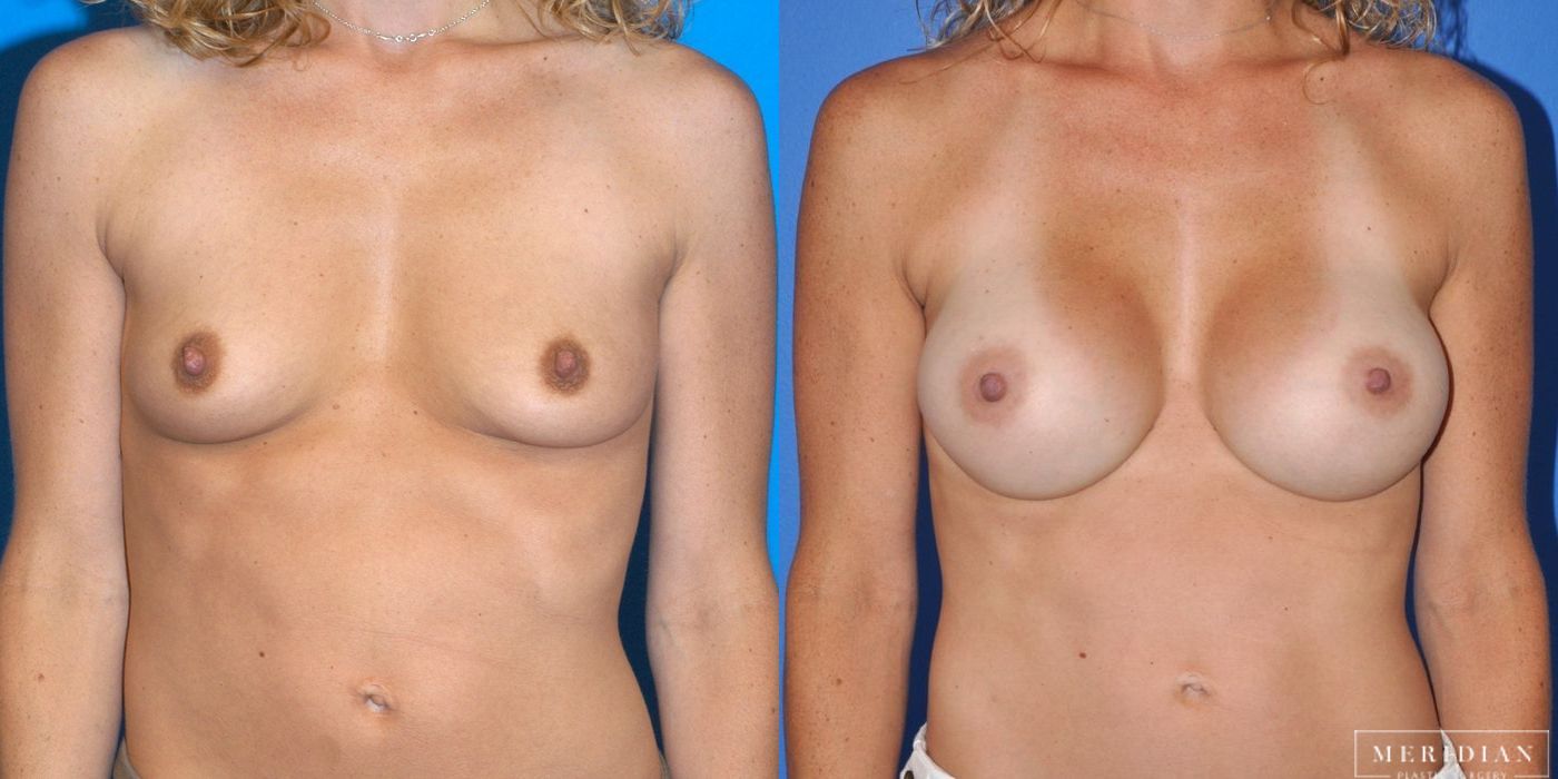 Breast Augmentation - Case 8509