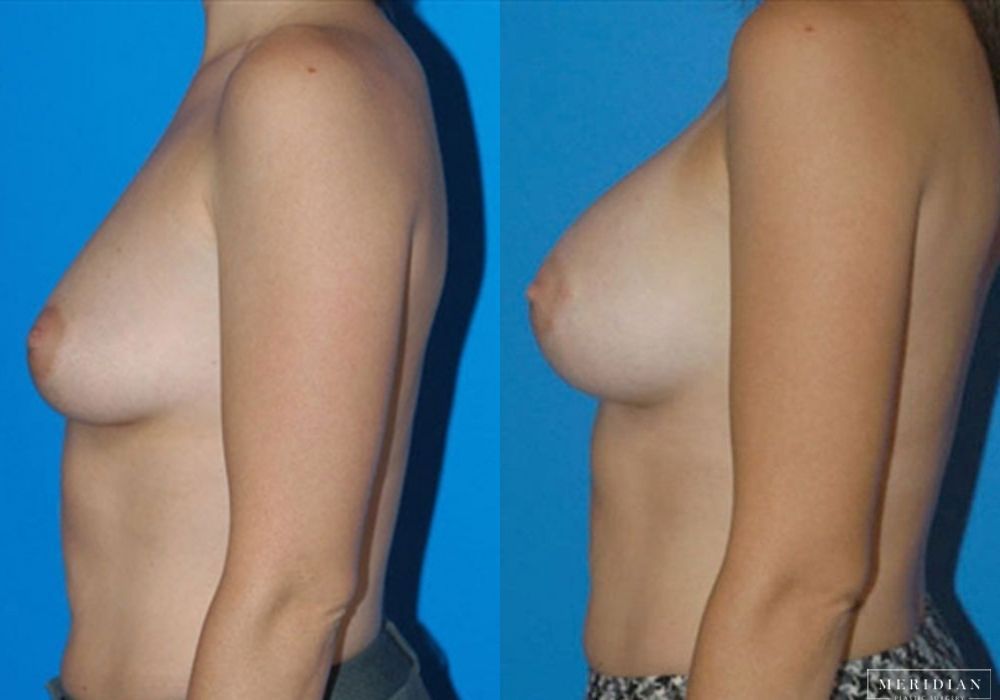 Breast Augmentation - Thumbnail 2
