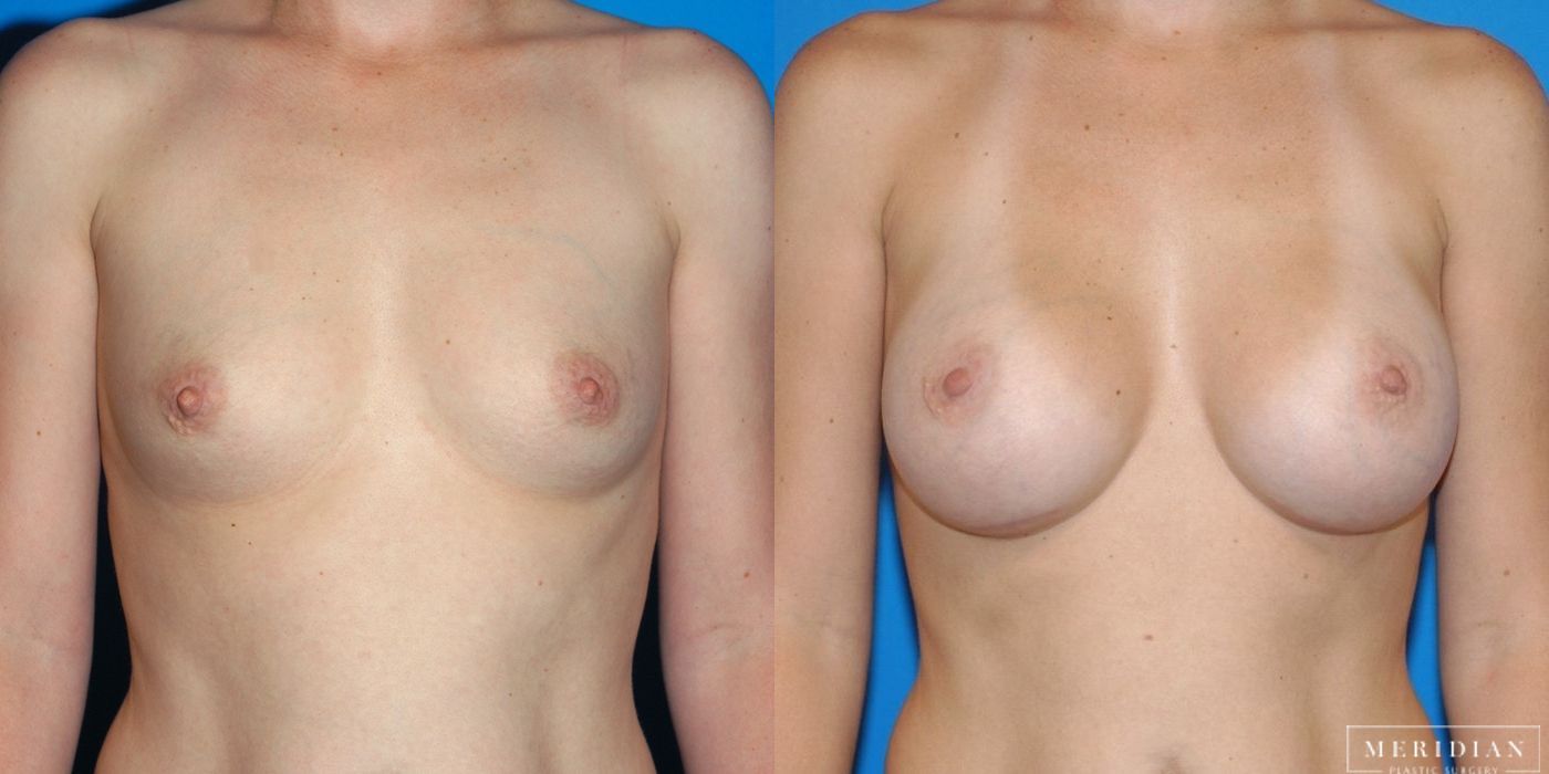Breast Augmentation - Thumbnail 2