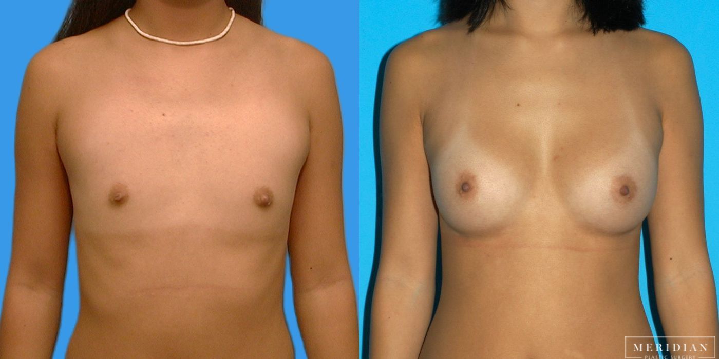 Breast Augmentation - Case 8016