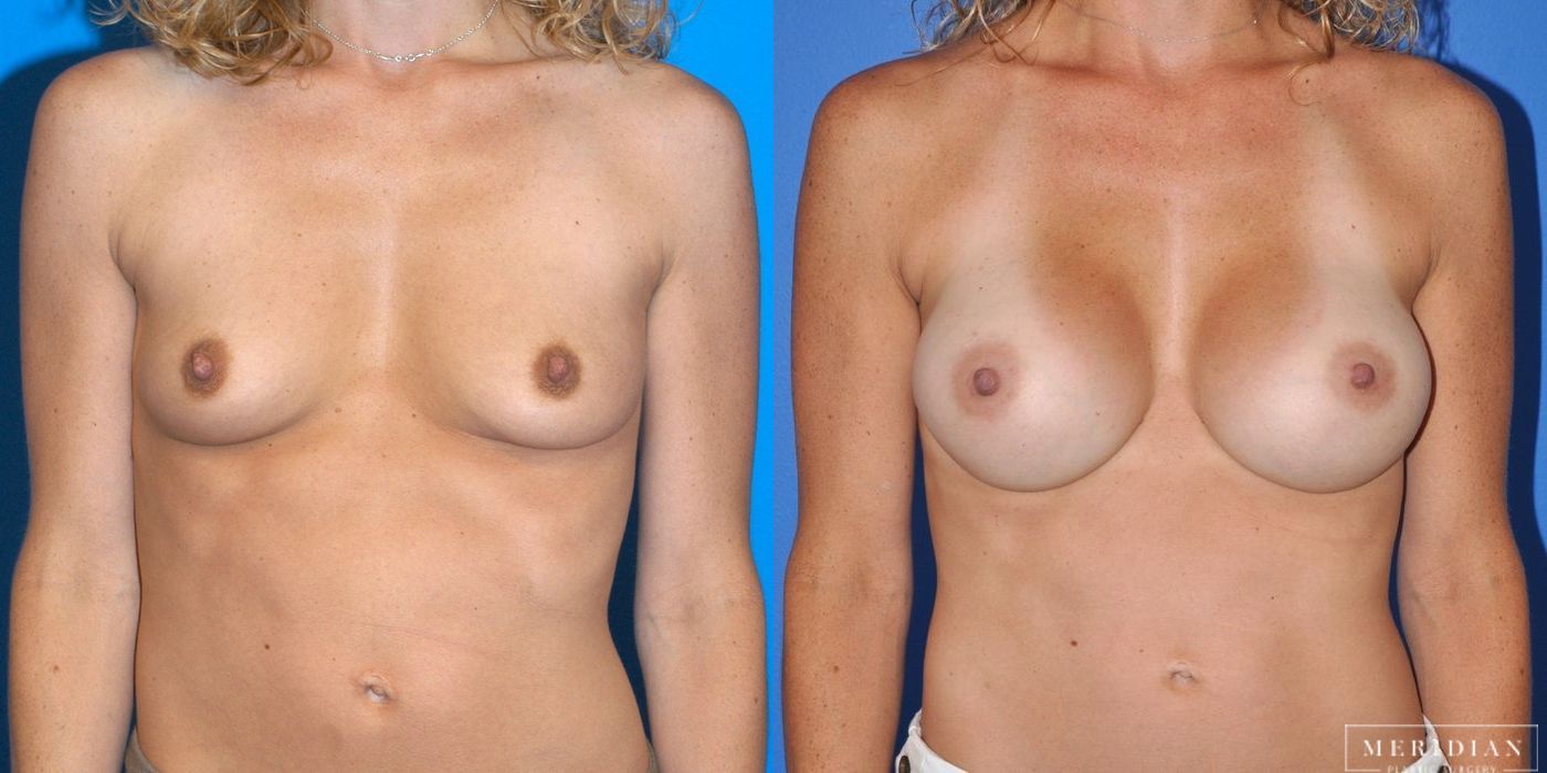 Breast Augmentation - Case 8026