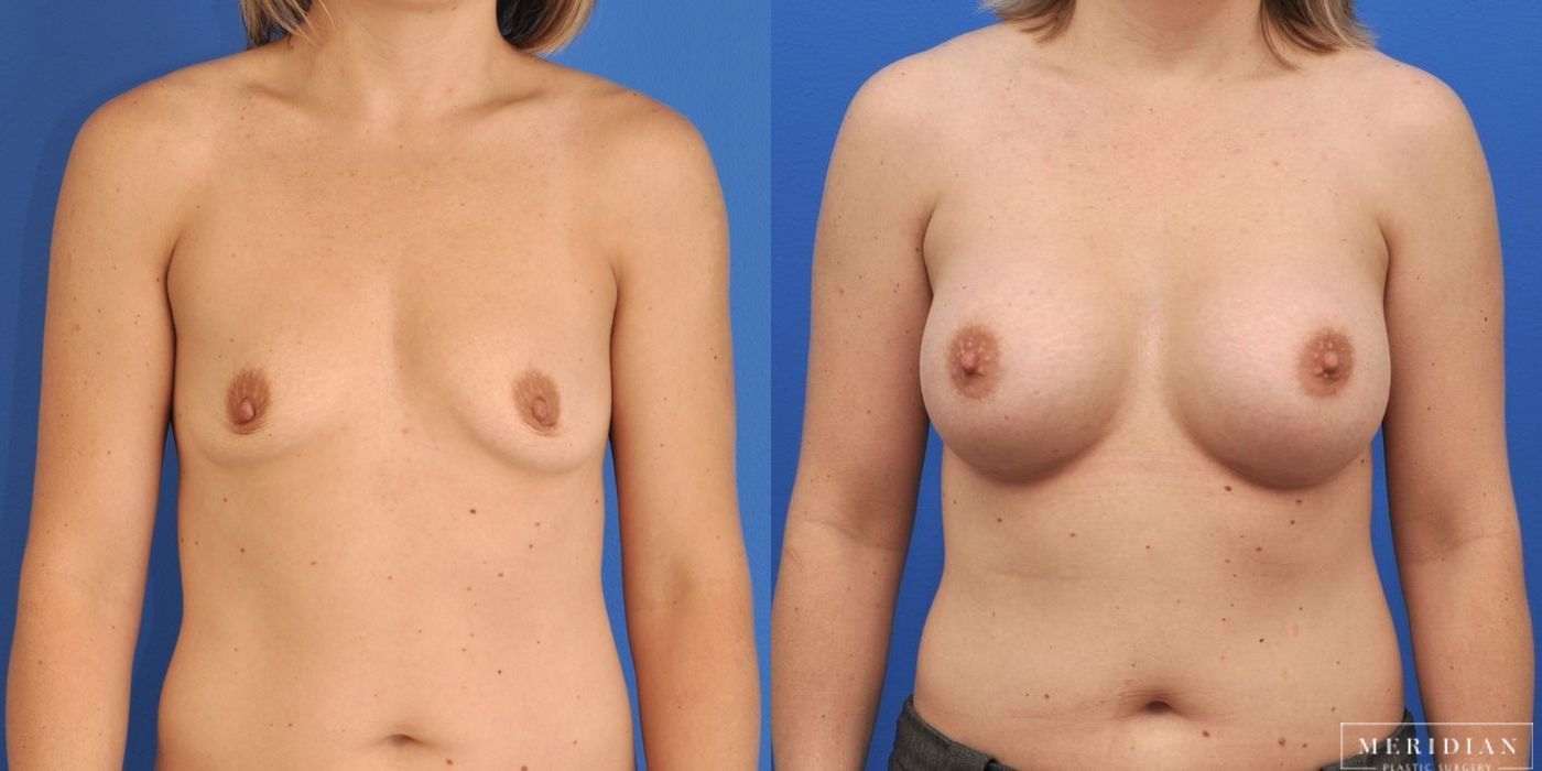Breast Augmentation - Case 8541