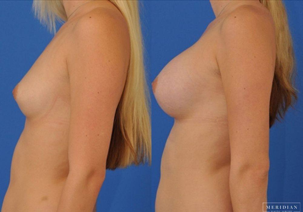 Breast Augmentation - Thumbnail 2