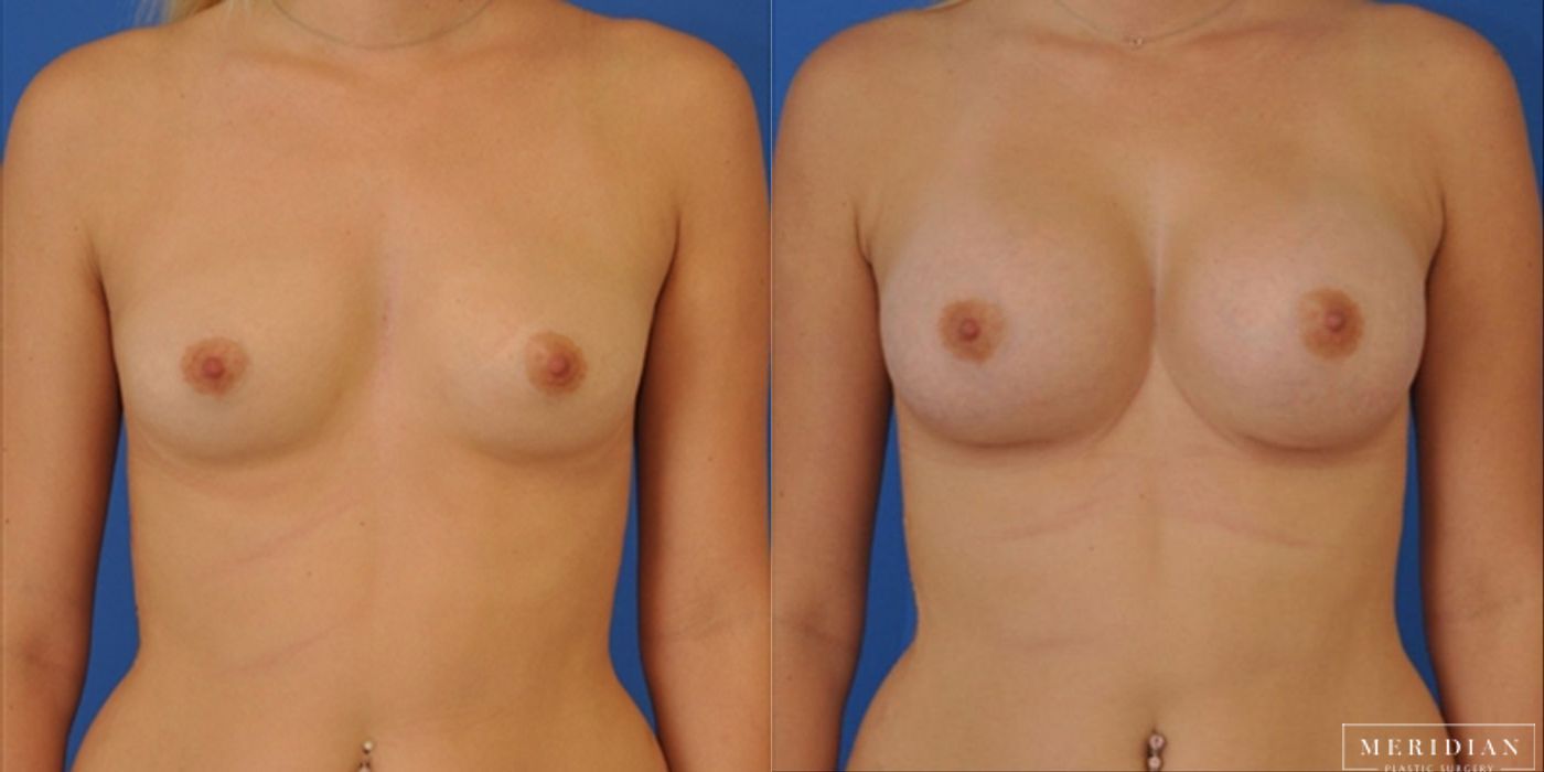 Breast Augmentation - Thumbnail 2