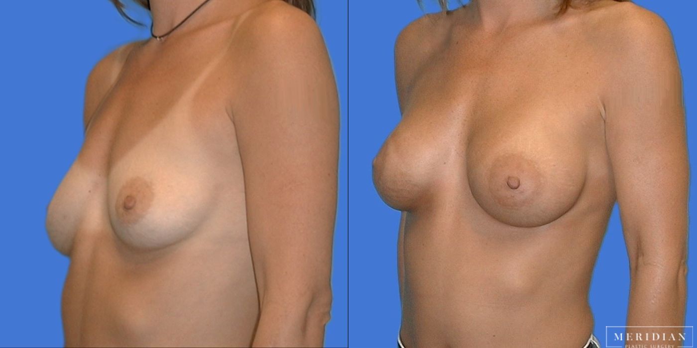Breast Augmentation - Case 8501