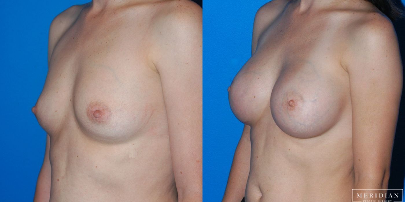 Breast Augmentation - Thumbnail 3