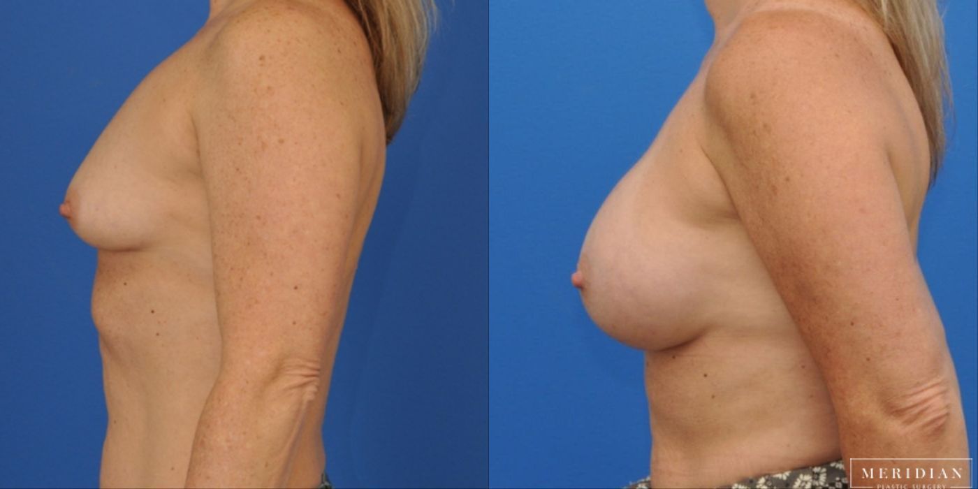 Breast Augmentation - Thumbnail 3