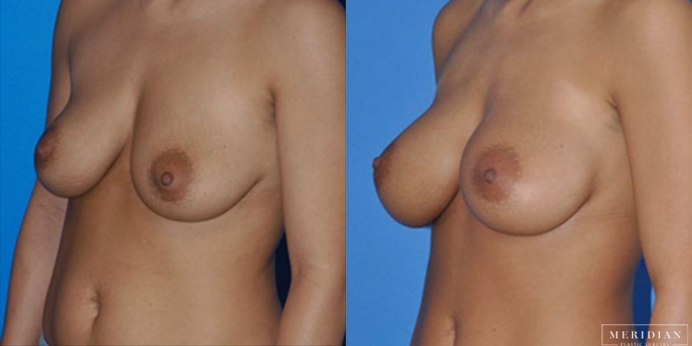 Breast Augmentation - Thumbnail 2