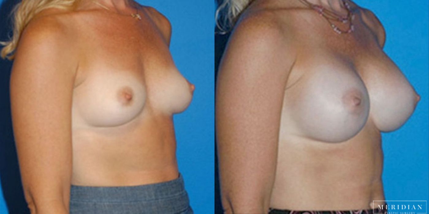 Breast Augmentation - Case 8522