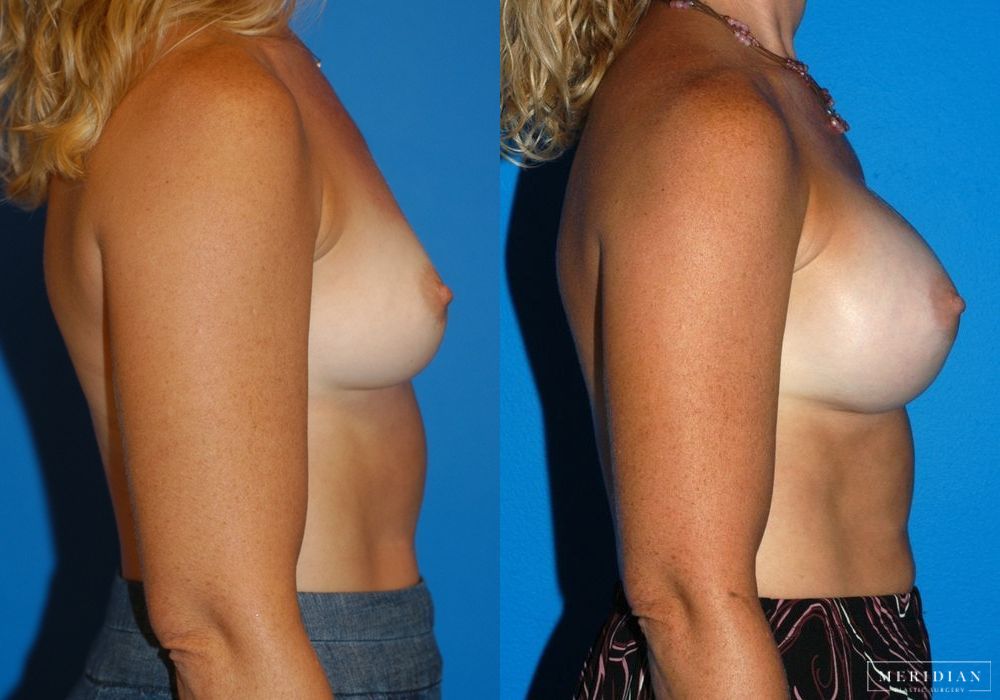 Breast Augmentation - Thumbnail 2