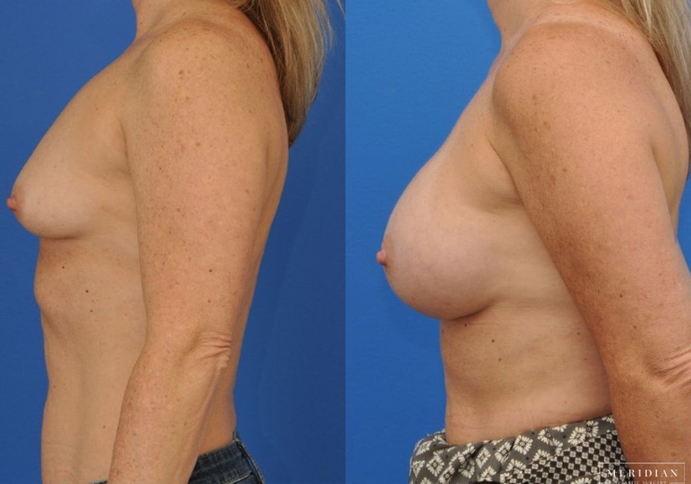 Breast Augmentation - Thumbnail 3