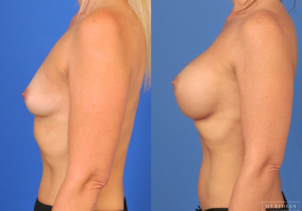 Breast Augmentation - Thumbnail 3