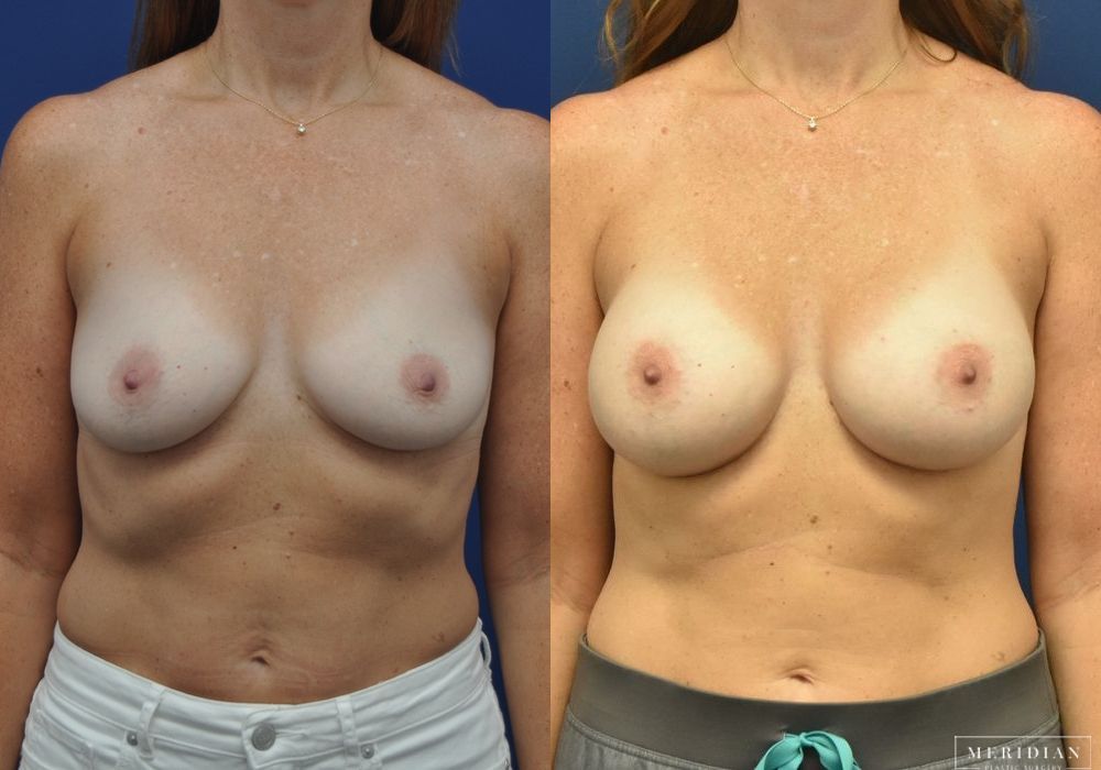 Breast Augmentation - Case 8046