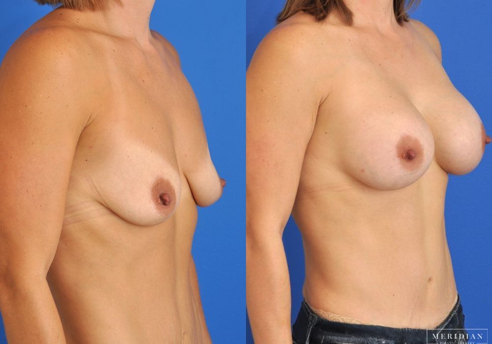 Breast Augmentation - Thumbnail 2