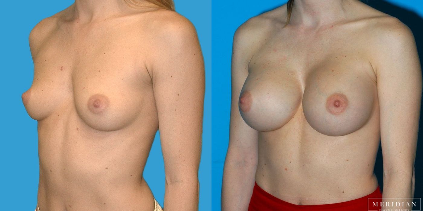 Breast Augmentation - Case 8540