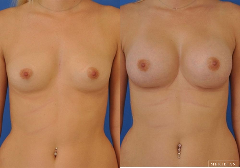 Breast Augmentation - Case 8041