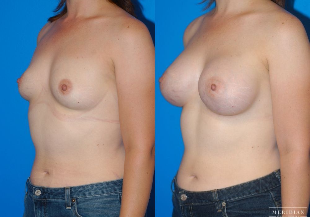 Breast Augmentation - Thumbnail 2