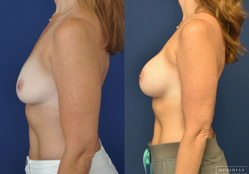 Breast Augmentation - Thumbnail 3