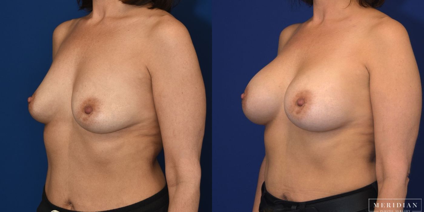 Breast Augmentation - Thumbnail 2