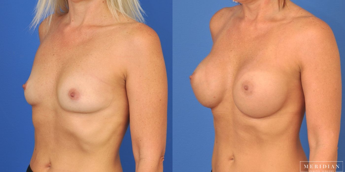 Breast Augmentation - Thumbnail 2