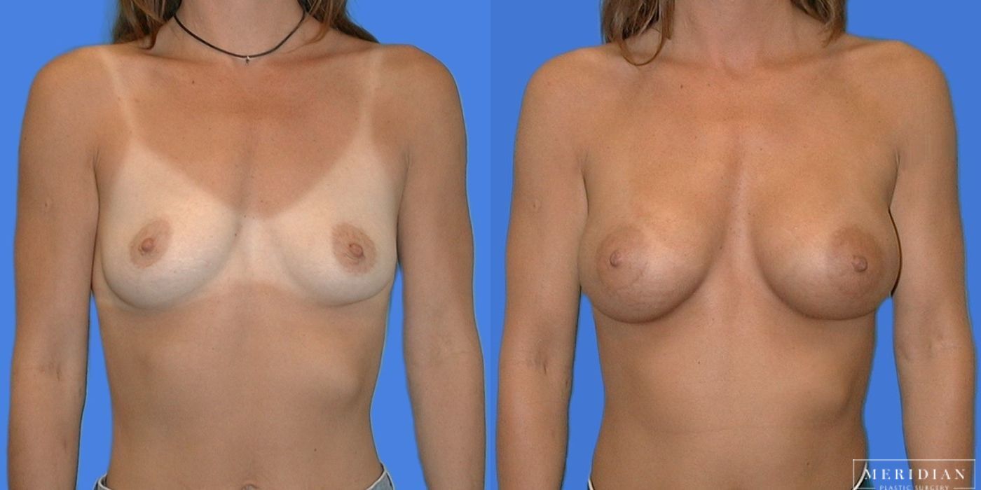 Breast Augmentation - Case 8018
