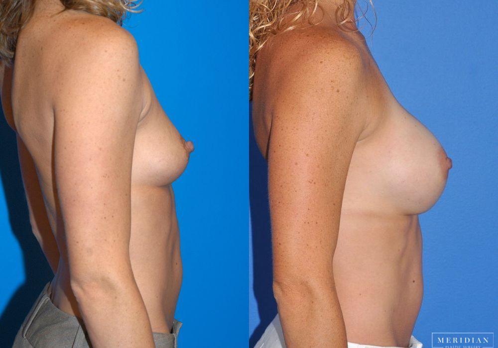 Breast Augmentation - Thumbnail 3