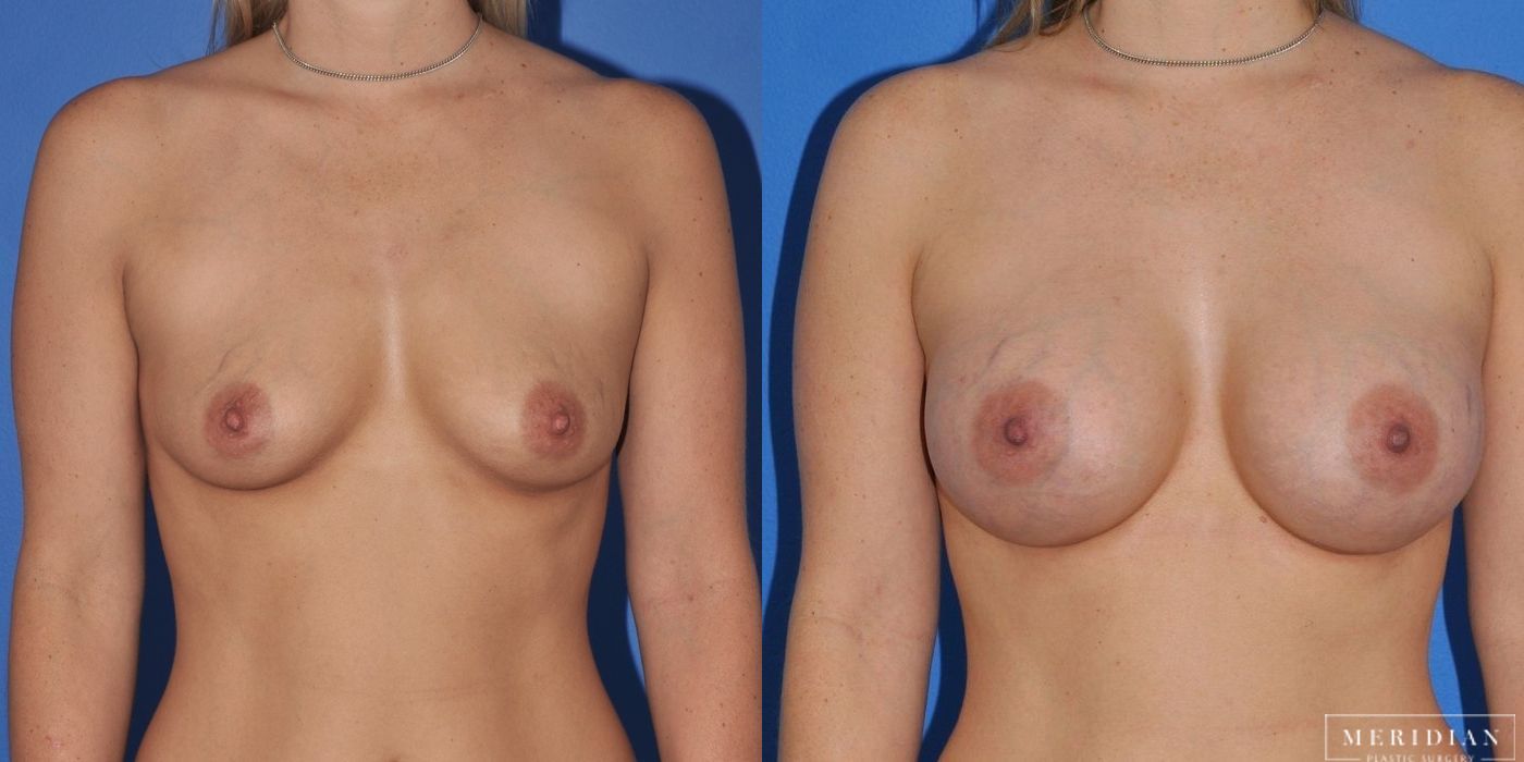 Breast Augmentation - Case 8023