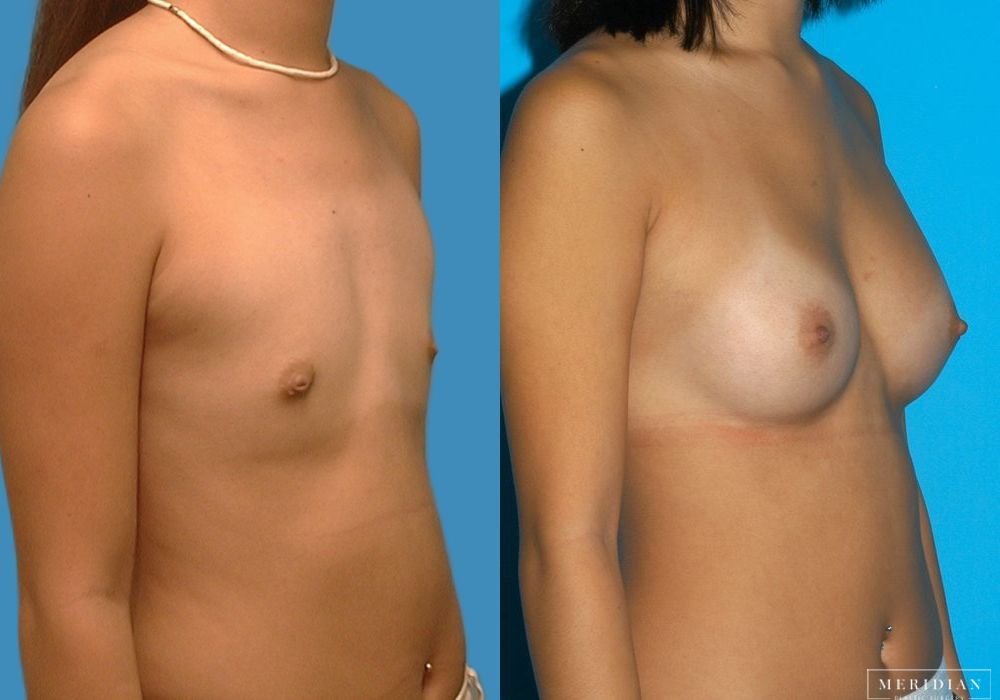 Breast Augmentation - Thumbnail 2