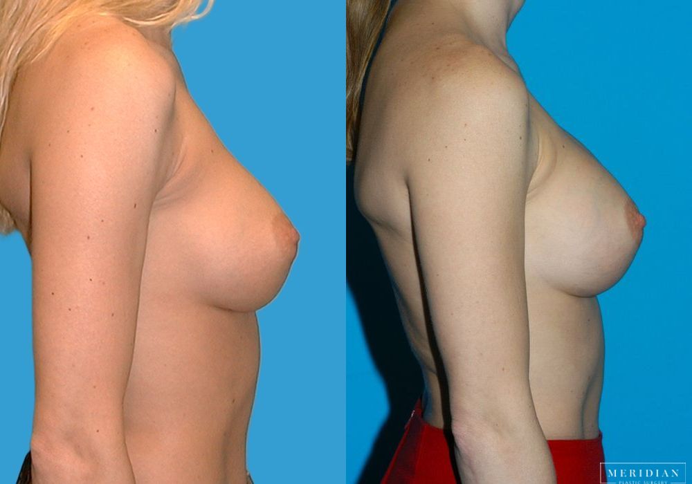 Breast Augmentation - Thumbnail 2