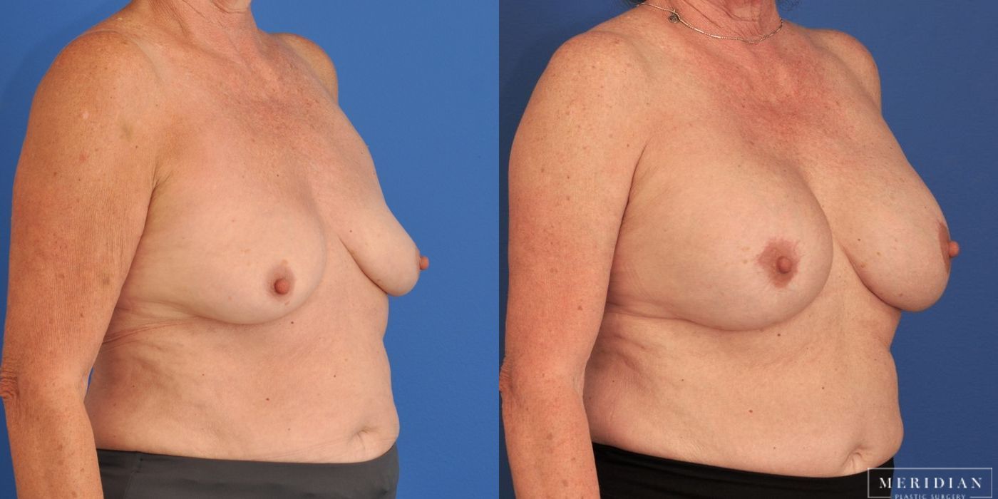 Breast Augmentation - Thumbnail 2