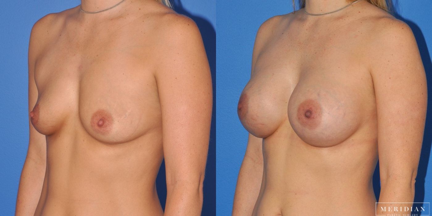 Breast Augmentation - Thumbnail 2