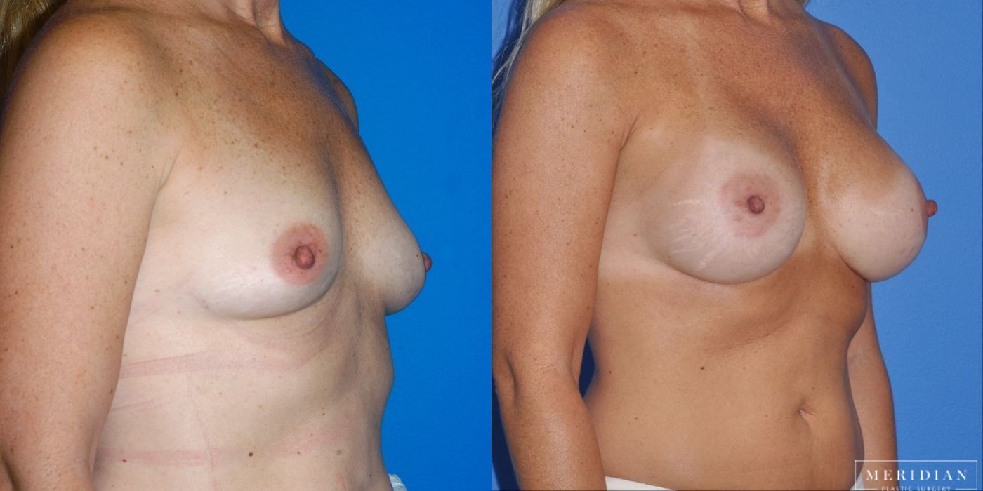 Breast Augmentation - Thumbnail 2