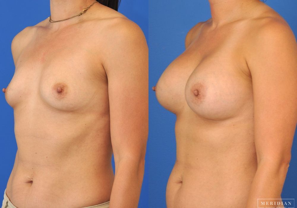 Breast Augmentation - Thumbnail 2