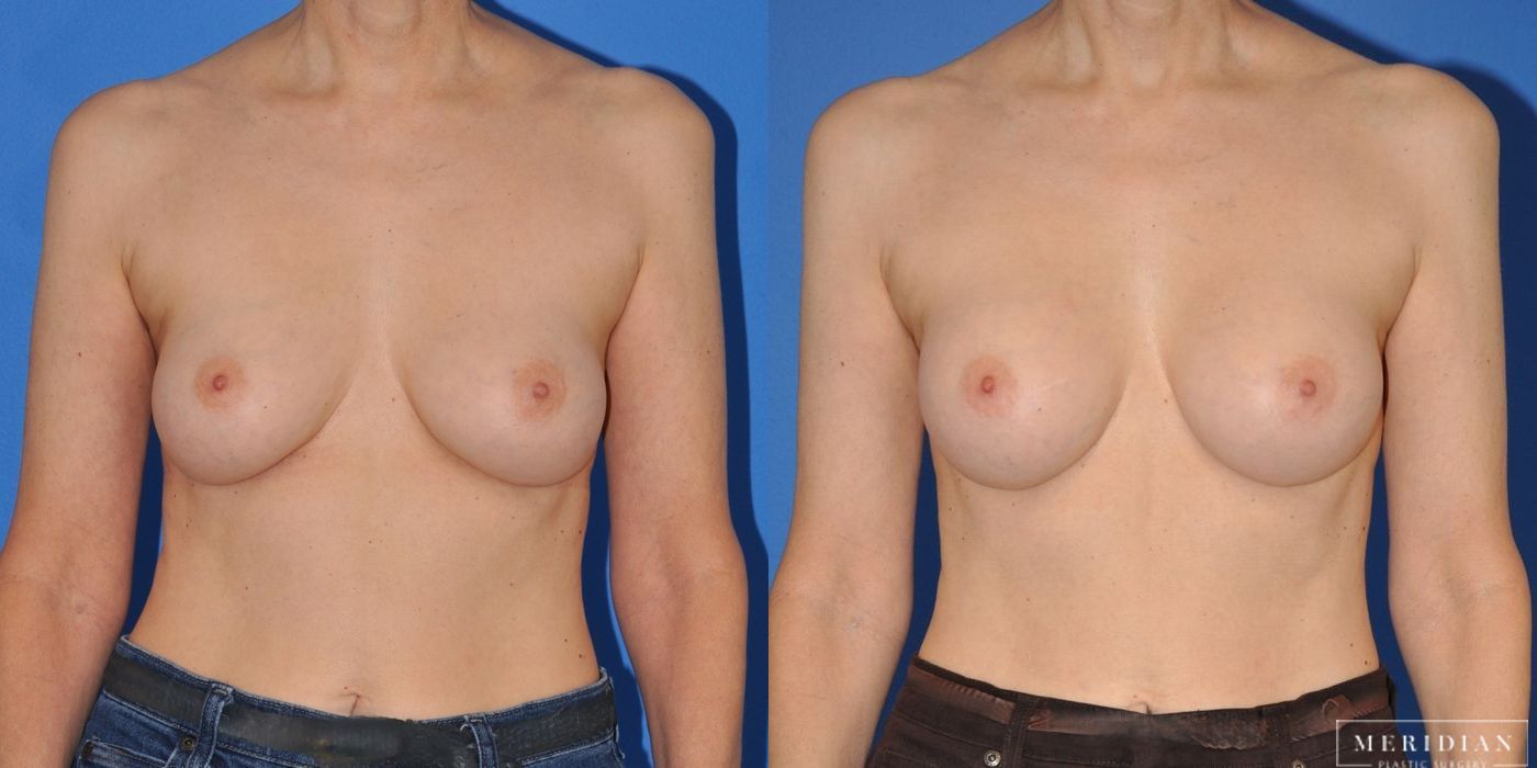 Breast Augmentation - Case 8535
