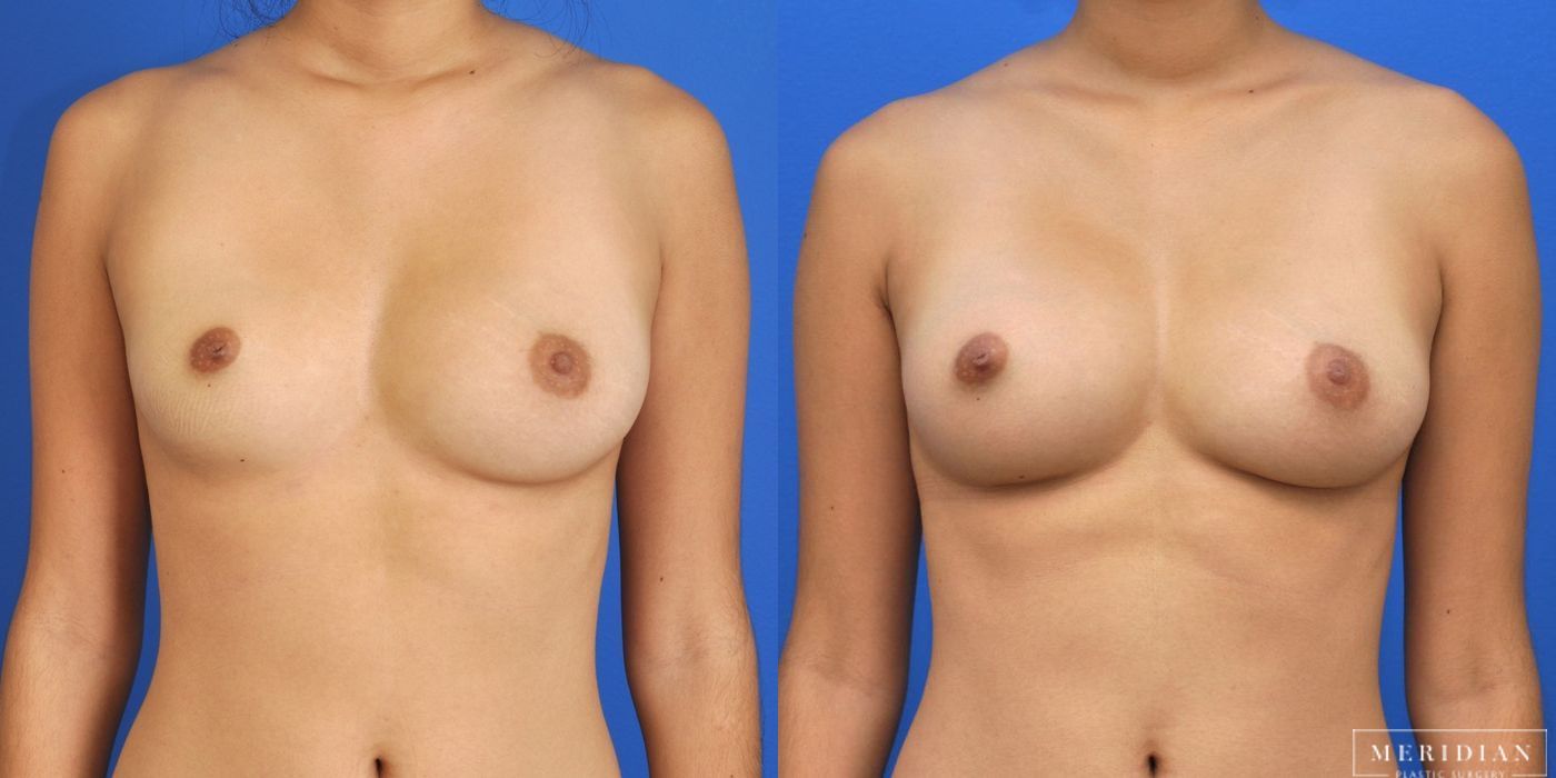 Breast Augmentation - Case 8017