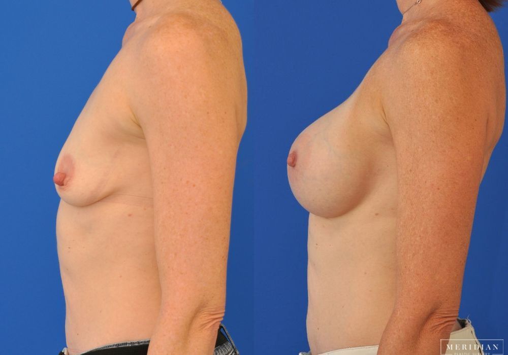 Breast Augmentation - Thumbnail 3