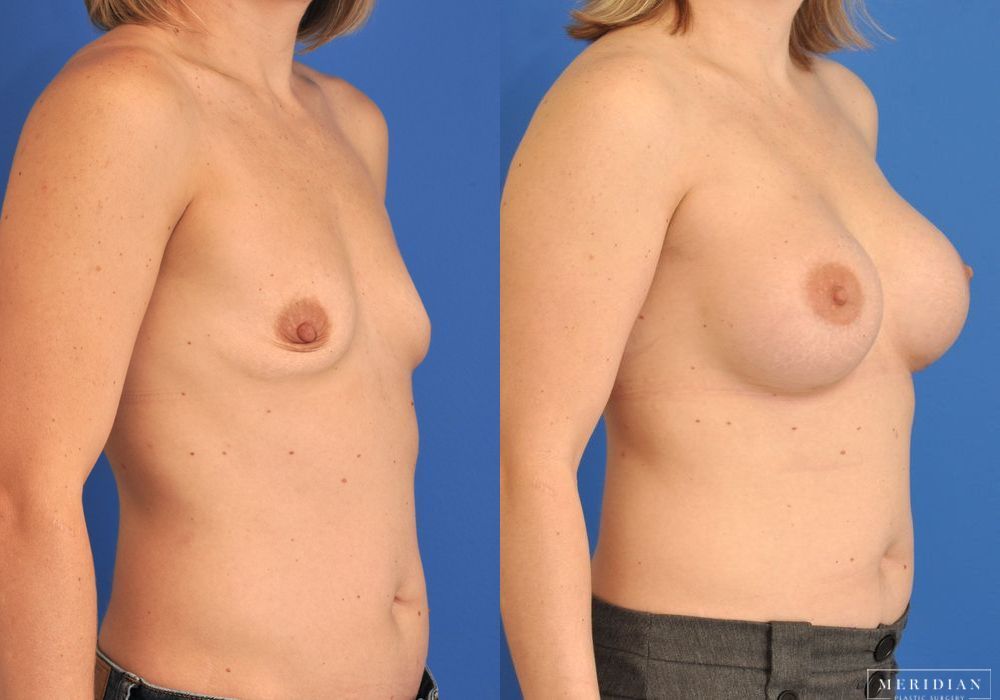 Breast Augmentation - Thumbnail 2