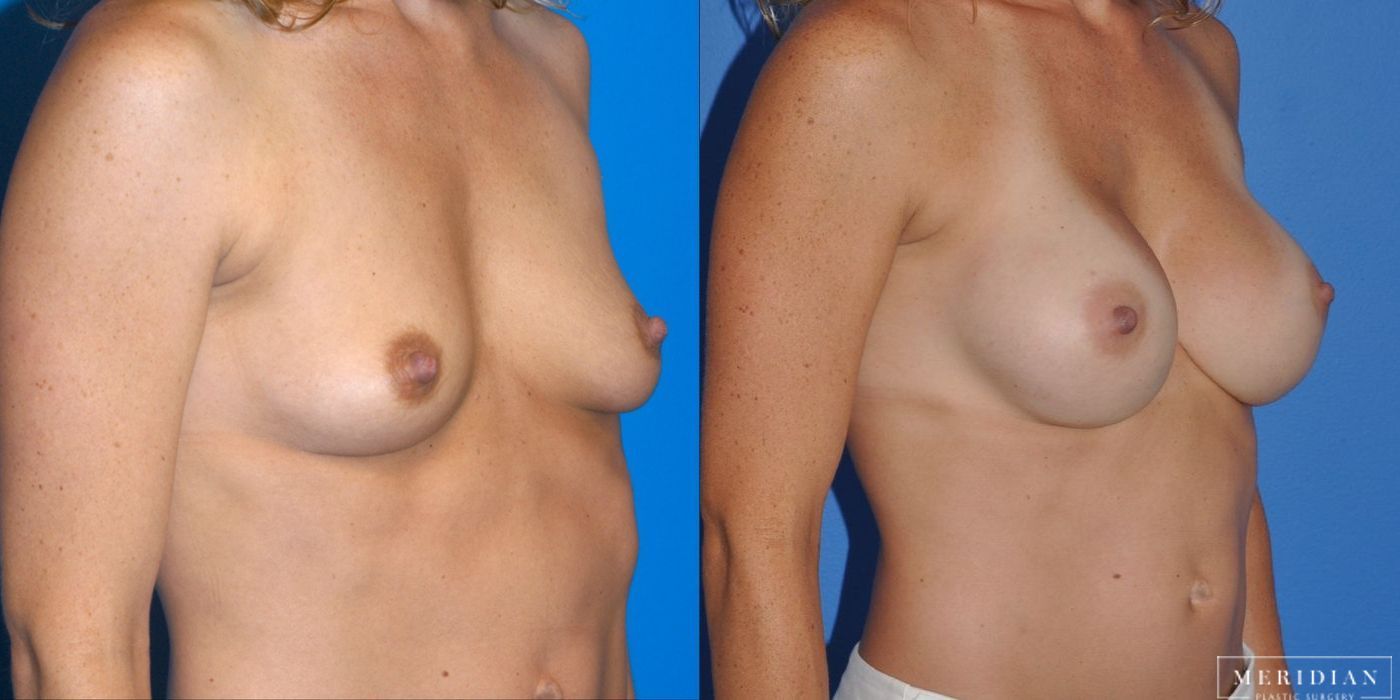Breast Augmentation - Thumbnail 2