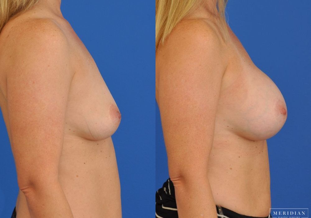 Breast Augmentation - Thumbnail 2