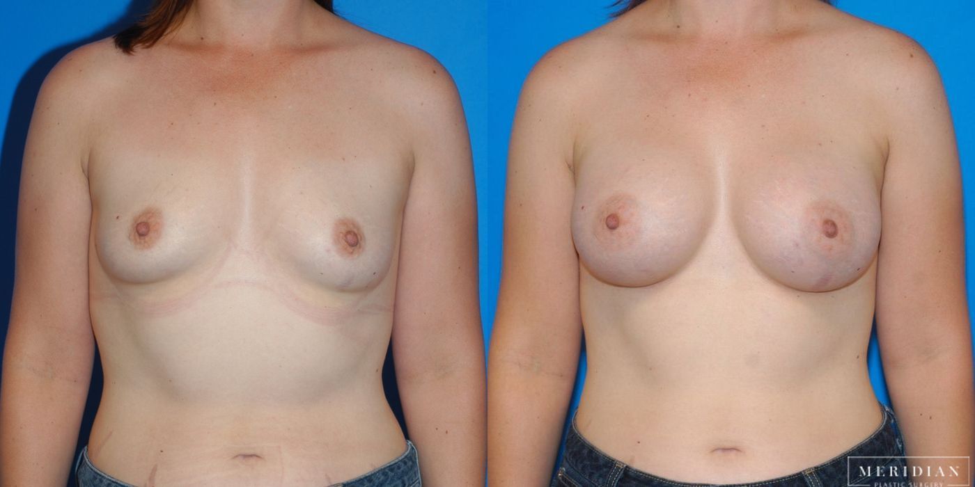 Breast Augmentation - Case 8028