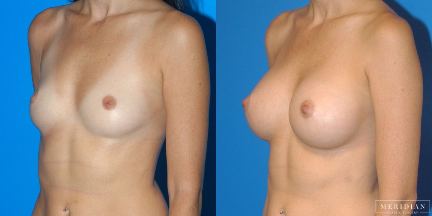 Breast Augmentation - Case 8723