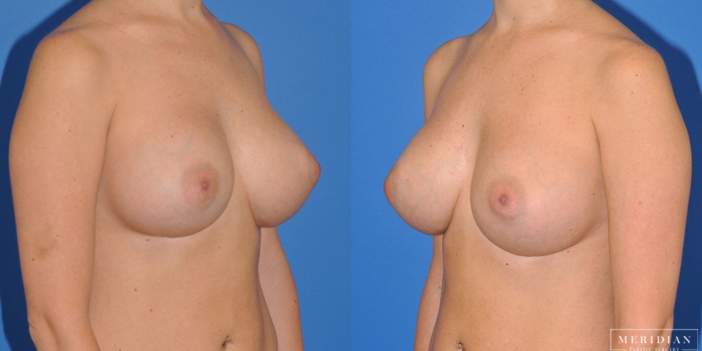 Breast Augmentation - Thumbnail 3