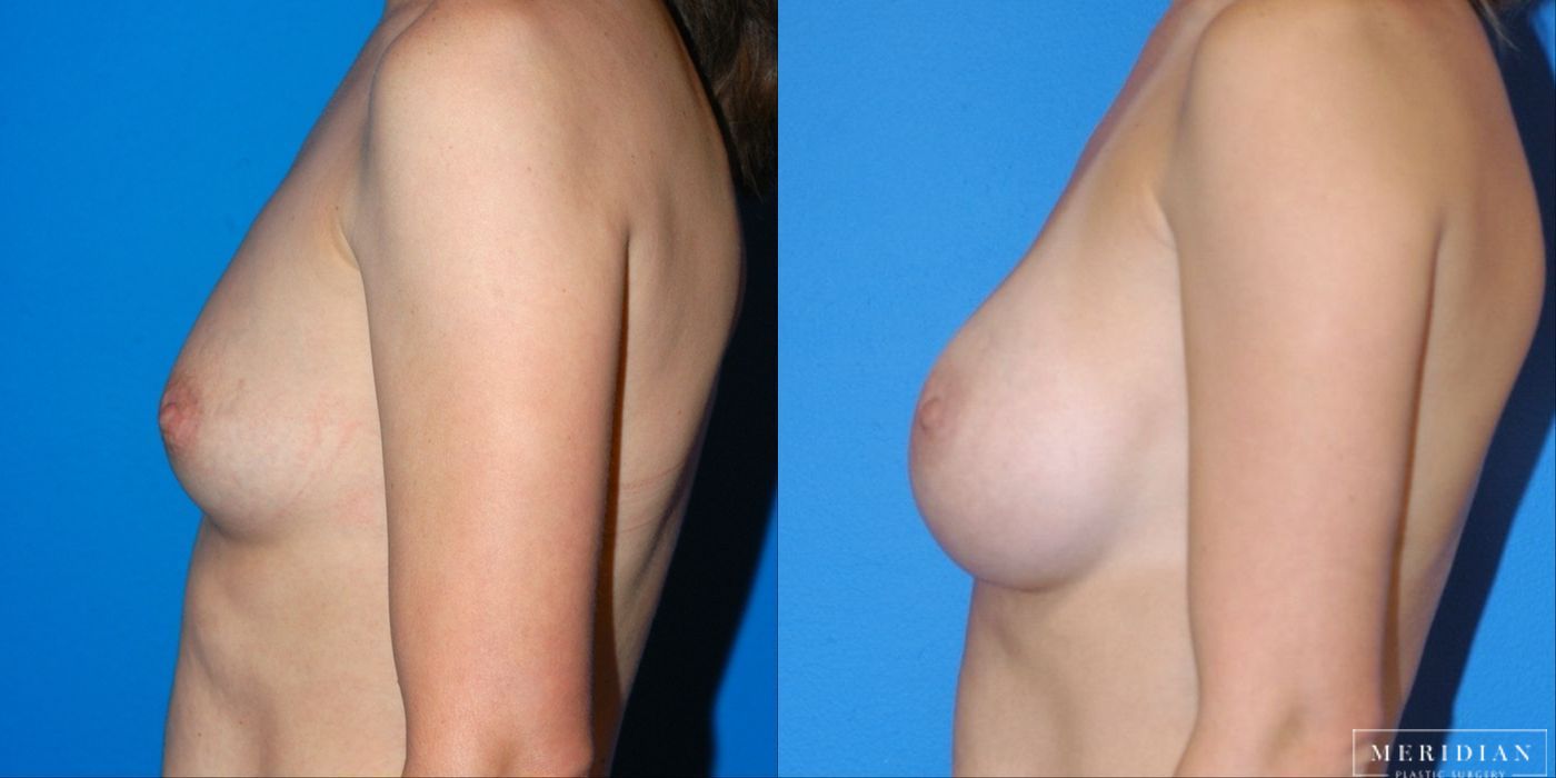 Breast Augmentation - Case 8536