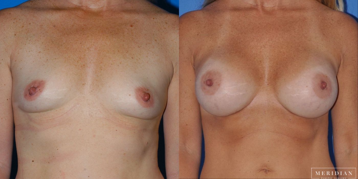 Breast Augmentation - Case 8537
