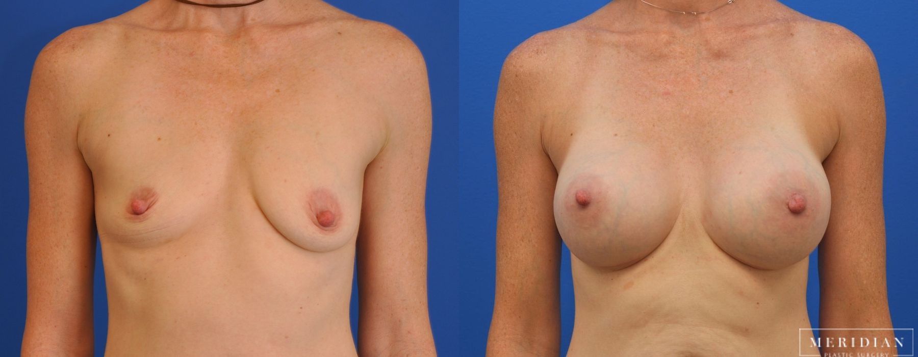 Breast Augmentation - Case 8019