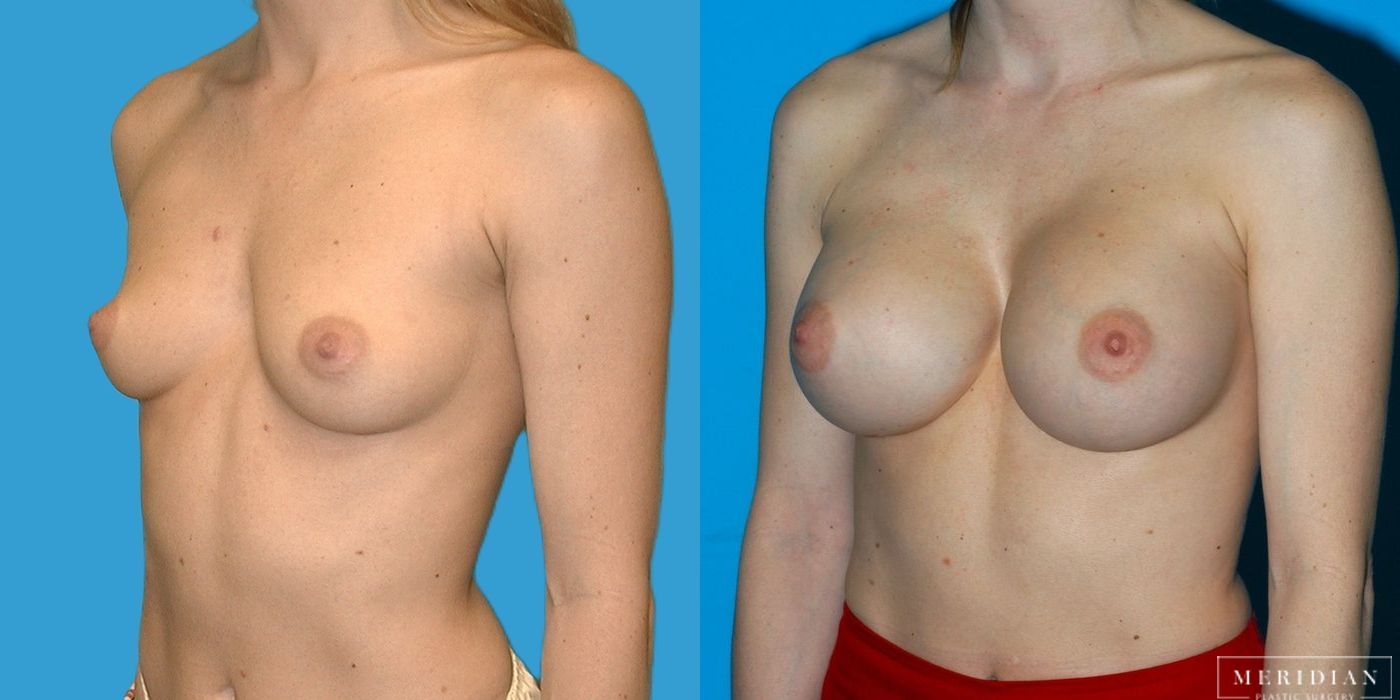 Breast Augmentation - Case 8057