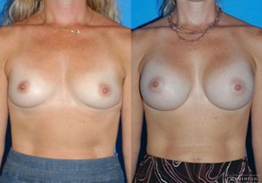 Breast Augmentation - Case 8039